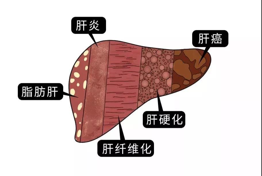 脂肪肝的最大敵人不是肥胖，答案竟是這樣！