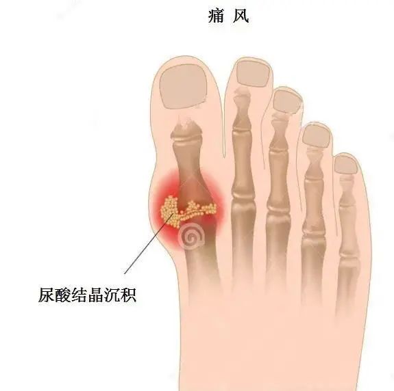 痛風(fēng)為什么偏愛(ài)男性？你最關(guān)心的問(wèn)題都在這里