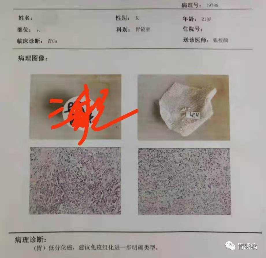 醫(yī)生總結(jié)了3位年輕胃癌患者的病例：30歲不到的他們到底干啥了？