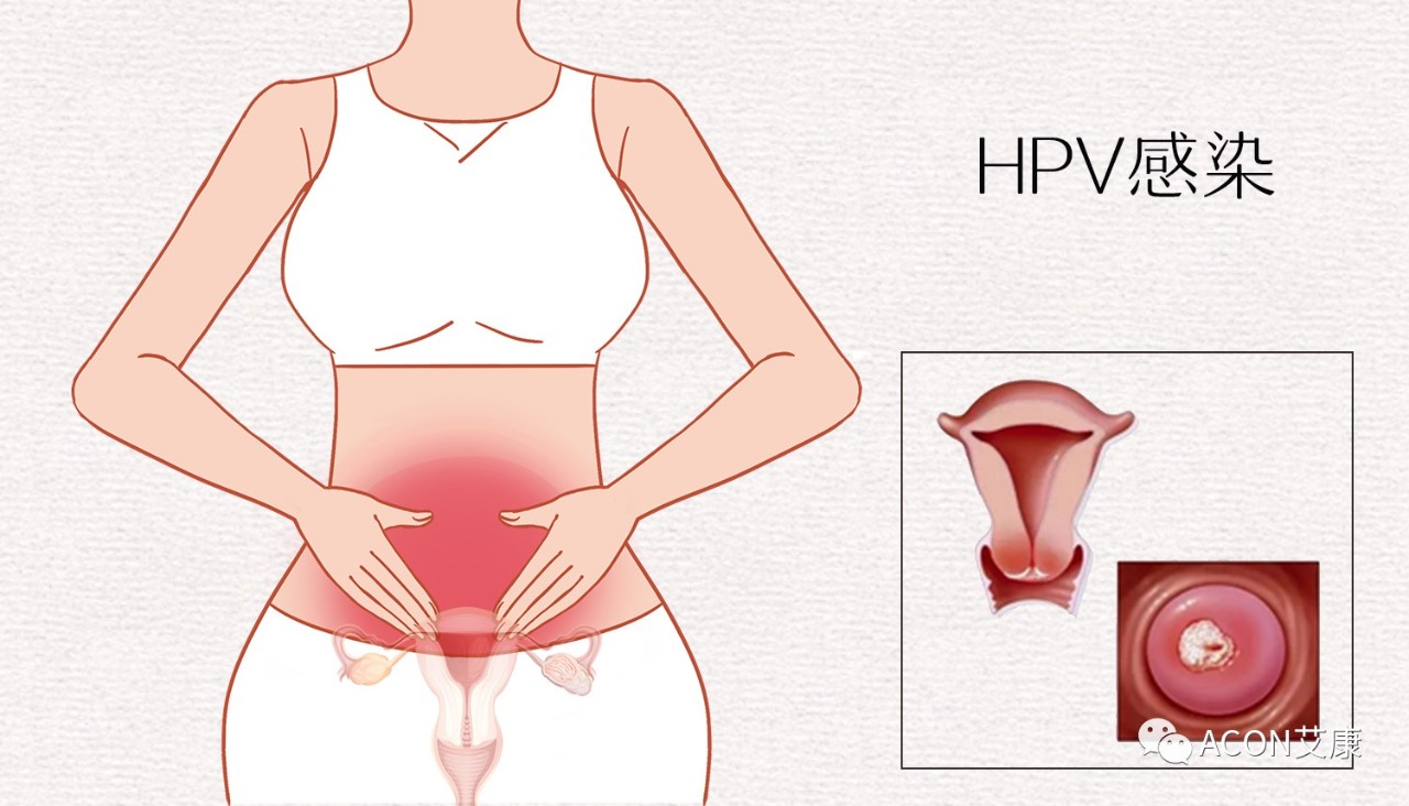 HPV轉(zhuǎn)陰其實很簡單， 女性必知的宮頸癌真相