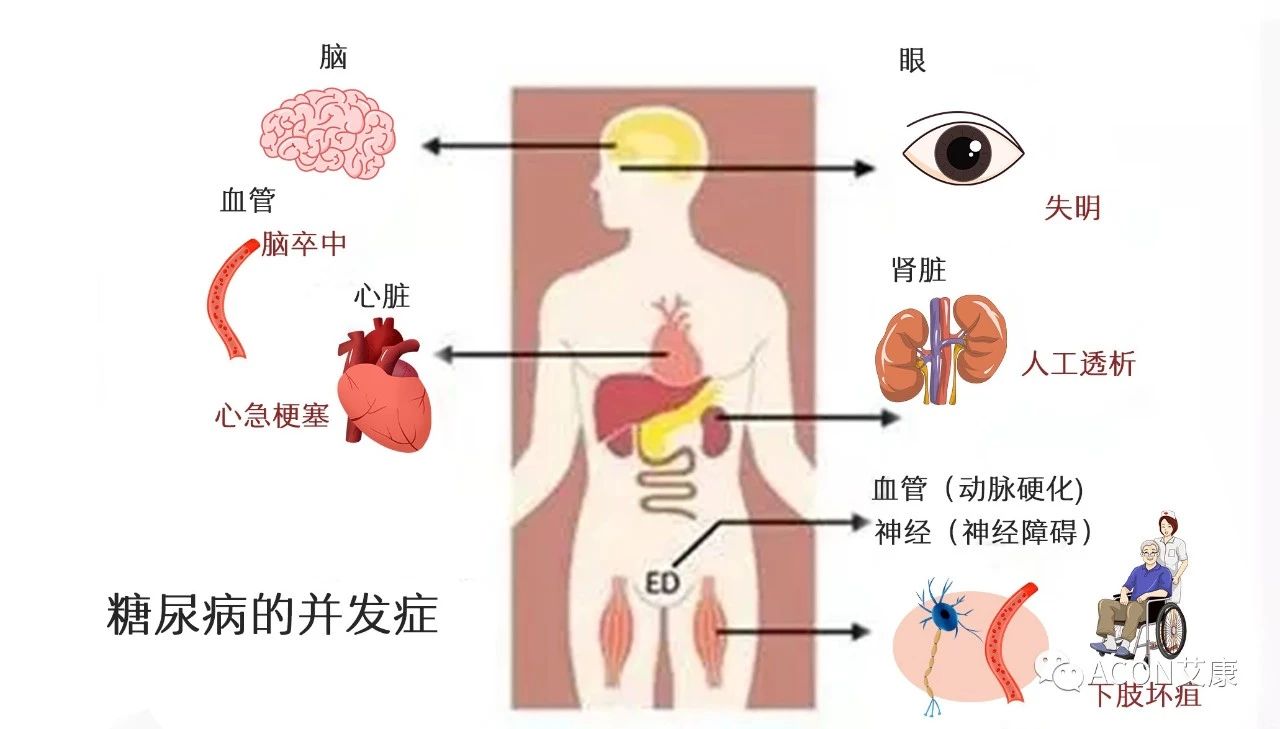 爆上熱搜，因爆發(fā)型糖尿病進(jìn)入ICU，有哪些教訓(xùn)值得我們汲取