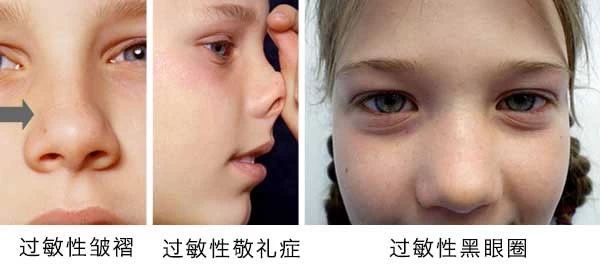 過敏性鼻炎會讓孩子變傻？！家長該如何應對